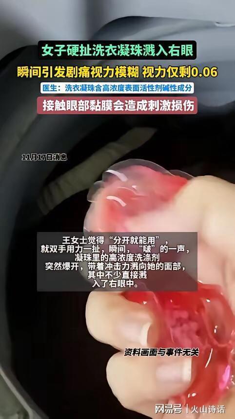 杭州一女子撕扯凝珠发生意外致眼睛失明AG